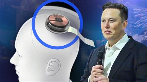 Cowen: Would you let Elon Musk implant a device in your brain?